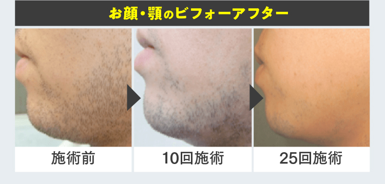 お顔・顎のビフォーアフター 施術前 10回施術 25回施術