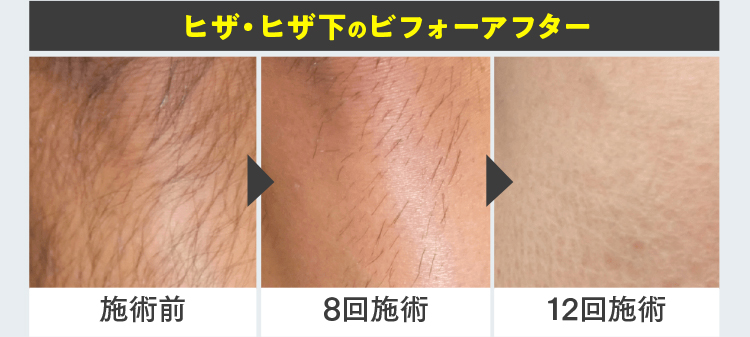 ヒザ・ヒザ下のビフォーアフター 施術前 8回施術 12回施術